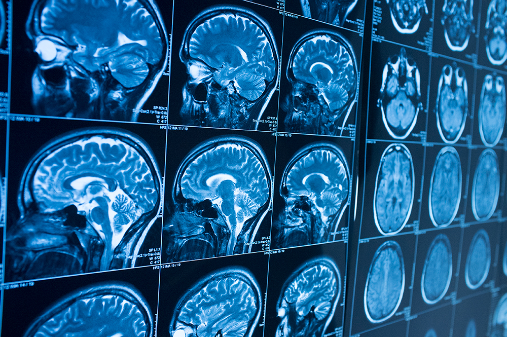 multiple images of cross section catscans of a human brain